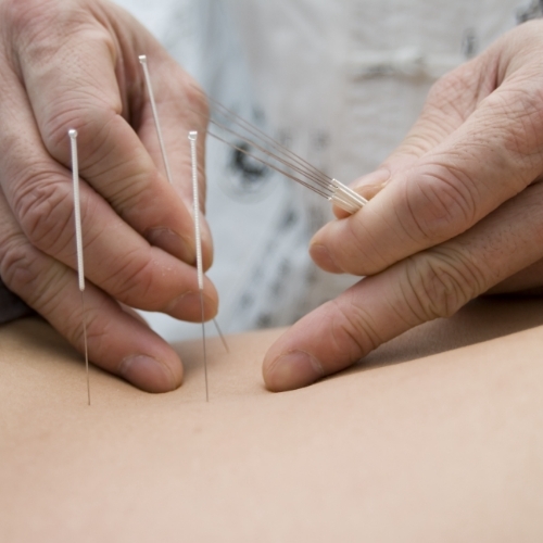 Therapist performing dry needling technique on patients back in order to alleviate pain.