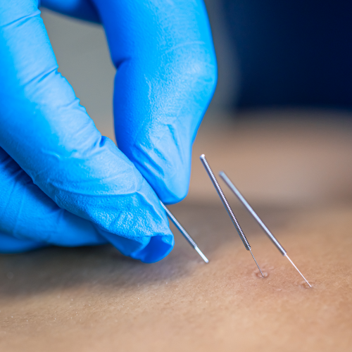 dry-needling-professional-therapy-partners-austin-san-antonio-nm
